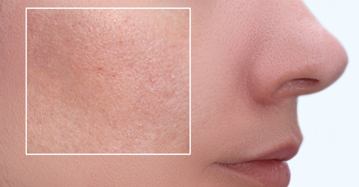 Melhor ativo do mercado para Poros Dilatados