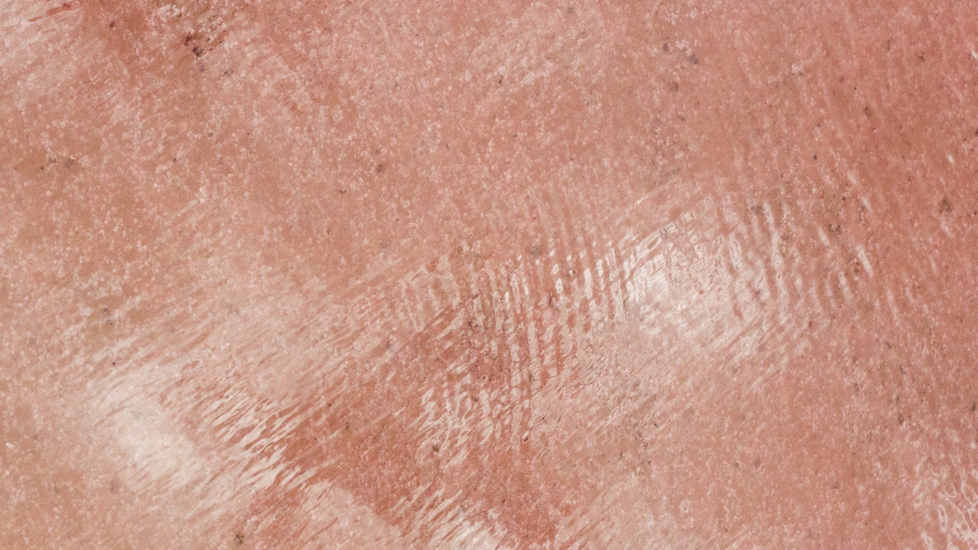 Melasma: Por que é tão difícil tratar e como controlar?